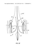 Everting Heart Valve diagram and image