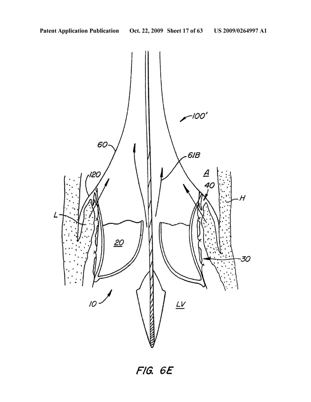 Everting Heart Valve - diagram, schematic, and image 18