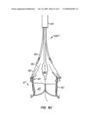 Everting Heart Valve diagram and image