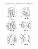 Everting Heart Valve diagram and image