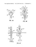 Everting Heart Valve diagram and image