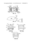 Everting Heart Valve diagram and image