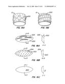 Everting Heart Valve diagram and image