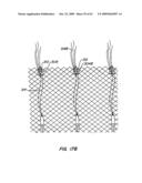 Everting Heart Valve diagram and image