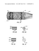 Everting Heart Valve diagram and image