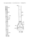 Everting Heart Valve diagram and image