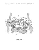 Everting Heart Valve diagram and image