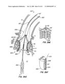 Everting Heart Valve diagram and image