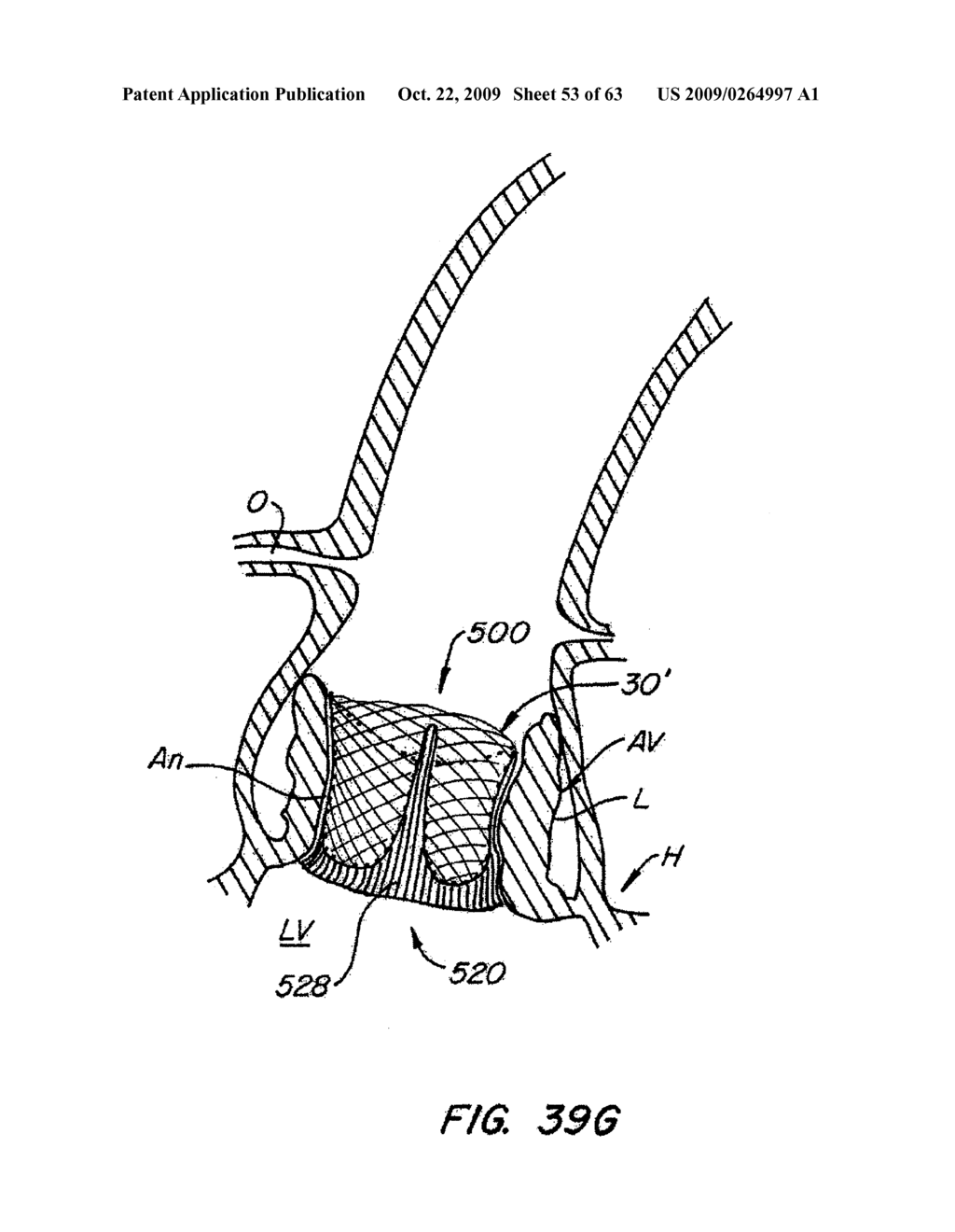 Everting Heart Valve - diagram, schematic, and image 54