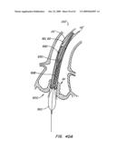 Everting Heart Valve diagram and image