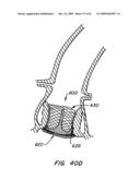 Everting Heart Valve diagram and image