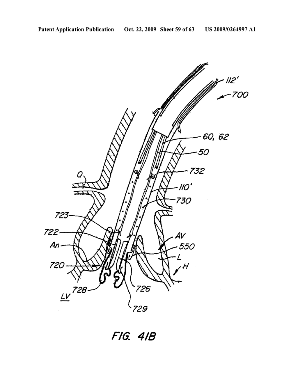 Everting Heart Valve - diagram, schematic, and image 60