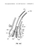 Everting Heart Valve diagram and image