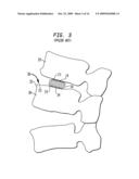 Spinal implant apparatus and methods diagram and image