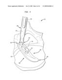 Spinal implant apparatus and methods diagram and image