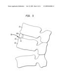 Spinal implant apparatus and methods diagram and image