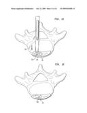 Spinal implant apparatus and methods diagram and image