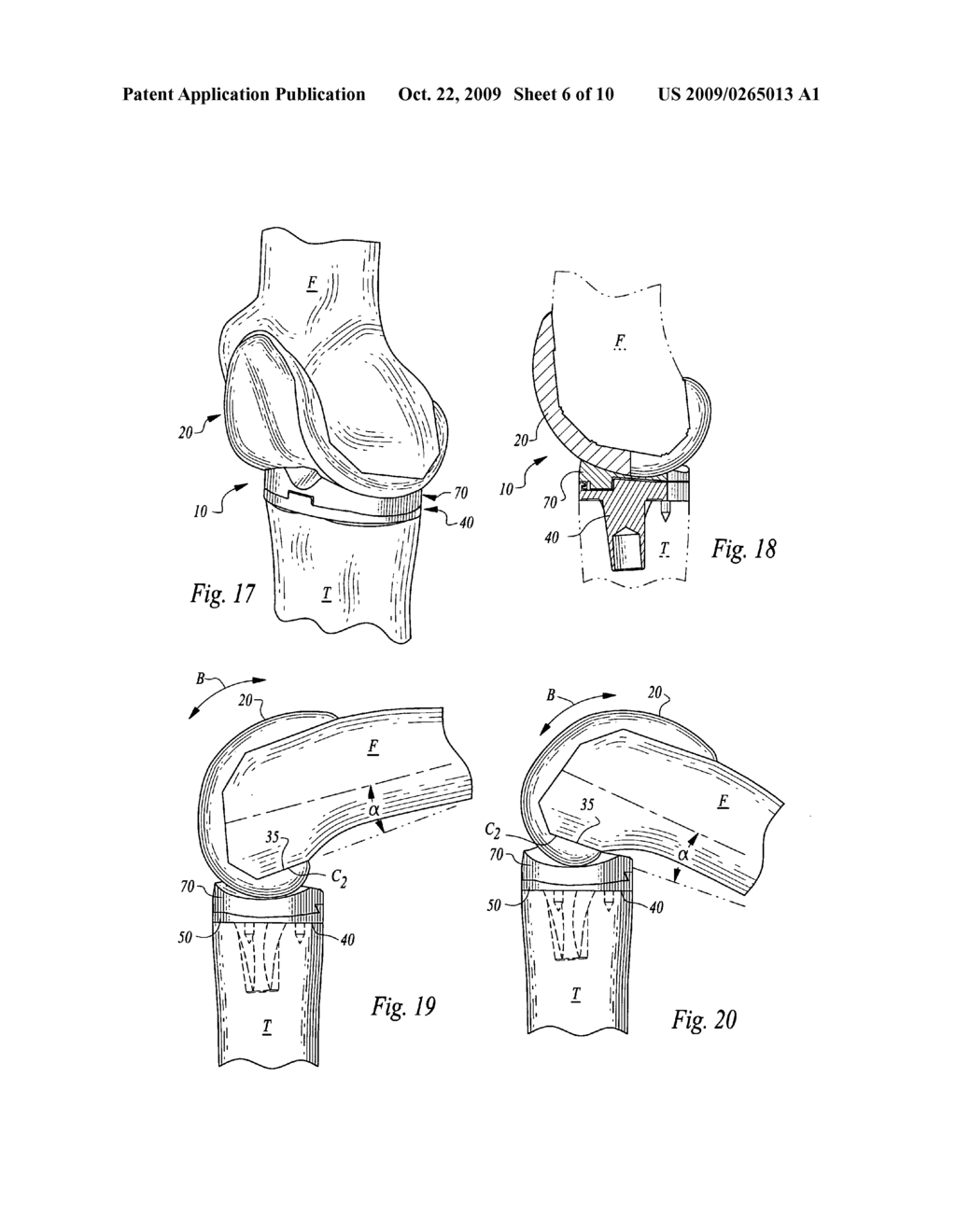 Tibial component of an artificial knee joint - diagram, schematic, and image 07