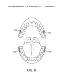 MICROPHONE PLACEMENT FOR ORAL APPLICATIONS diagram and image