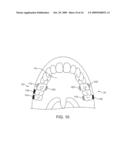 MICROPHONE PLACEMENT FOR ORAL APPLICATIONS diagram and image