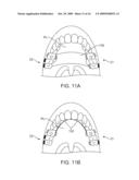 MICROPHONE PLACEMENT FOR ORAL APPLICATIONS diagram and image