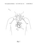 CORONARY SINUS LEAD DELIVERY CATHETER diagram and image