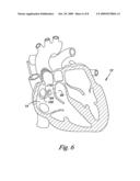 CORONARY SINUS LEAD DELIVERY CATHETER diagram and image