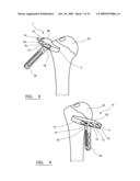 VARIABLE OFFSET REAMER ASSEMBLY FOR MODULAR HUMERAL COMPONENT diagram and image