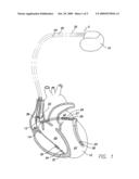 IMPLANTABLE MEDICAL DEVICE WITH COORDINATED VENTRICULAR OVERDRIVE AND TRIGGER MODE PACING diagram and image