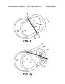 Methods and Devices for Improving Mitral Valve Function diagram and image