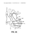 Methods and Devices for Improving Mitral Valve Function diagram and image