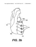 Methods and Devices for Improving Mitral Valve Function diagram and image