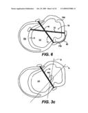 Methods and Devices for Improving Mitral Valve Function diagram and image