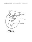 Methods and Devices for Improving Mitral Valve Function diagram and image