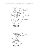 Methods and Devices for Improving Mitral Valve Function diagram and image