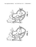 Methods and Devices for Improving Mitral Valve Function diagram and image