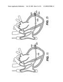 Methods and Devices for Improving Mitral Valve Function diagram and image