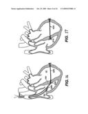 Methods and Devices for Improving Mitral Valve Function diagram and image