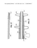 Methods and Devices for Improving Mitral Valve Function diagram and image