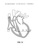 Methods and Devices for Improving Mitral Valve Function diagram and image