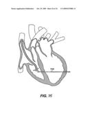 Methods and Devices for Improving Mitral Valve Function diagram and image