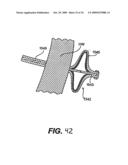 Methods and Devices for Improving Mitral Valve Function diagram and image