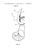 Medial and lateral femoral implants for single-compartment knee prosthesis diagram and image