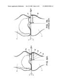 Medial and lateral femoral implants for single-compartment knee prosthesis diagram and image