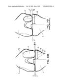 Medial and lateral femoral implants for single-compartment knee prosthesis diagram and image
