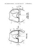 Medial and lateral femoral implants for single-compartment knee prosthesis diagram and image