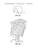 MINIMALLY-INVASIVE METHODS FOR IMPLANTING OBESITY TREATMENT DEVICES diagram and image