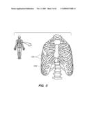 MINIMALLY-INVASIVE METHODS FOR IMPLANTING OBESITY TREATMENT DEVICES diagram and image