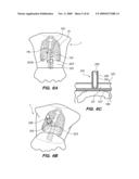 MINIMALLY-INVASIVE METHODS FOR IMPLANTING OBESITY TREATMENT DEVICES diagram and image