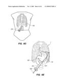 MINIMALLY-INVASIVE METHODS FOR IMPLANTING OBESITY TREATMENT DEVICES diagram and image